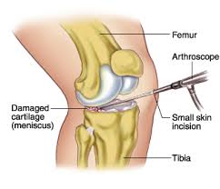 Knee Arthroscopy and Physiotherapy