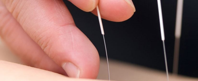 Dry Needling and Physiotherapy