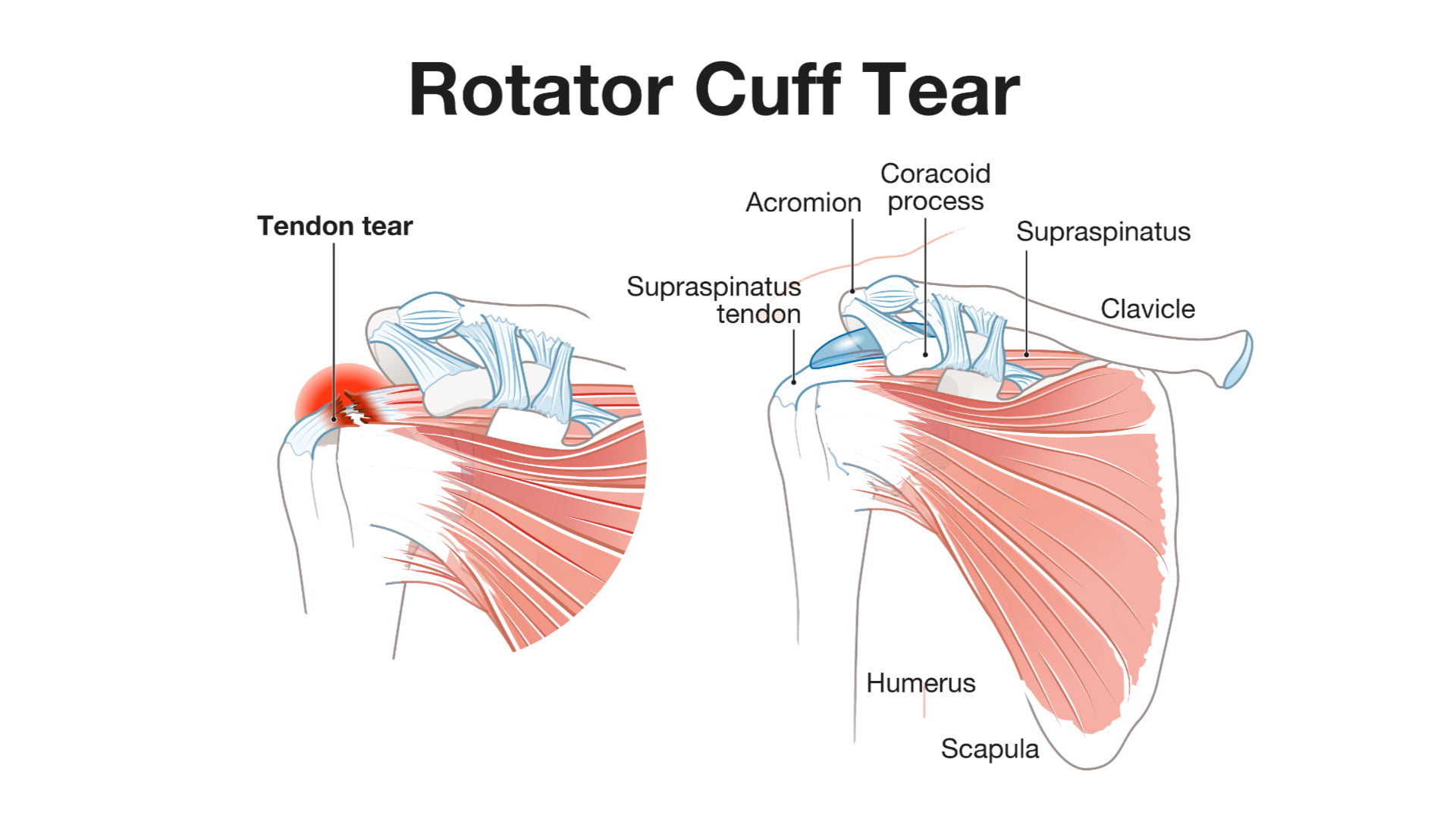 Illustration showing rotator cuff tear